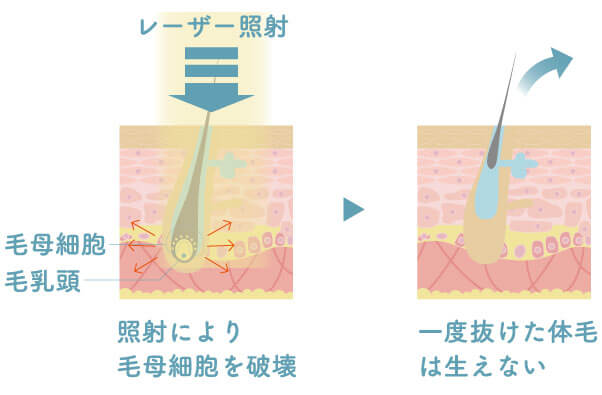 ミセルクリニック福岡院の医療レーザーの仕組み断面図。照射により毛母細胞を破壊。一度抜けた体毛は生えない。