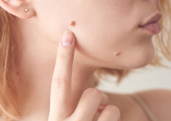 ミセルクリニック福岡院のほくろ除去 画像