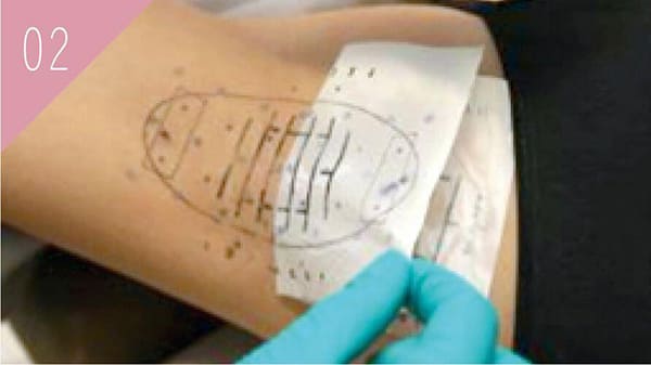 ミラドライ照射準備　マーキングにより範囲を確認している様子