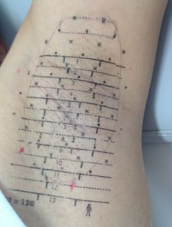 施術前に転写シートで照射範囲をマーキングしている様子