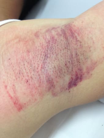 施術直後の様子