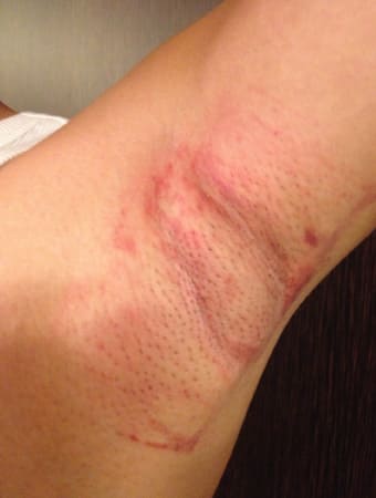 施術から3時間後の様子