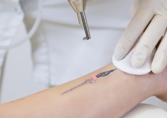 藤野メディカルクリニックのアザ・タトゥー除去（YAG1064） 画像