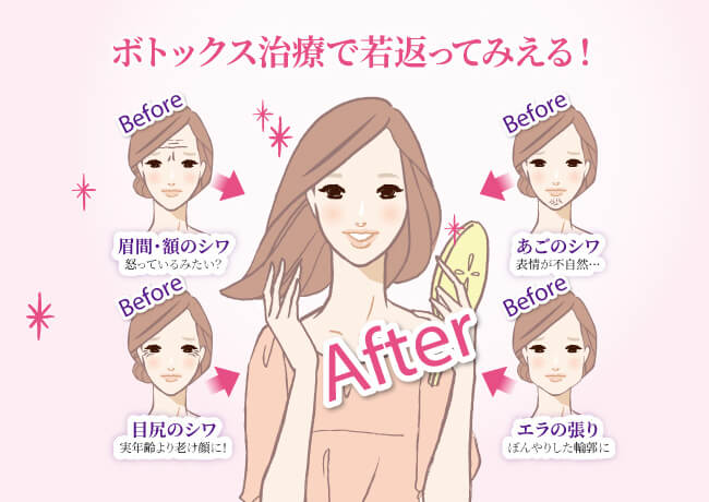 藤野クリニックのシワ・たるみ治療のビフォーアフターのイラスト